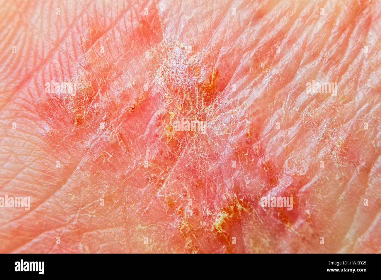 Macro shot of hand eczema Stock Photo