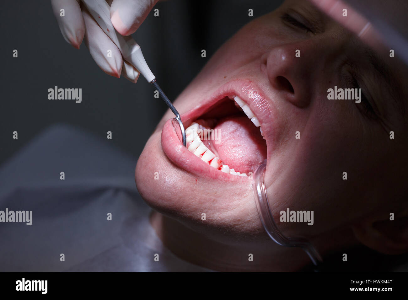 Periodontal probe hires stock photography and images Alamy