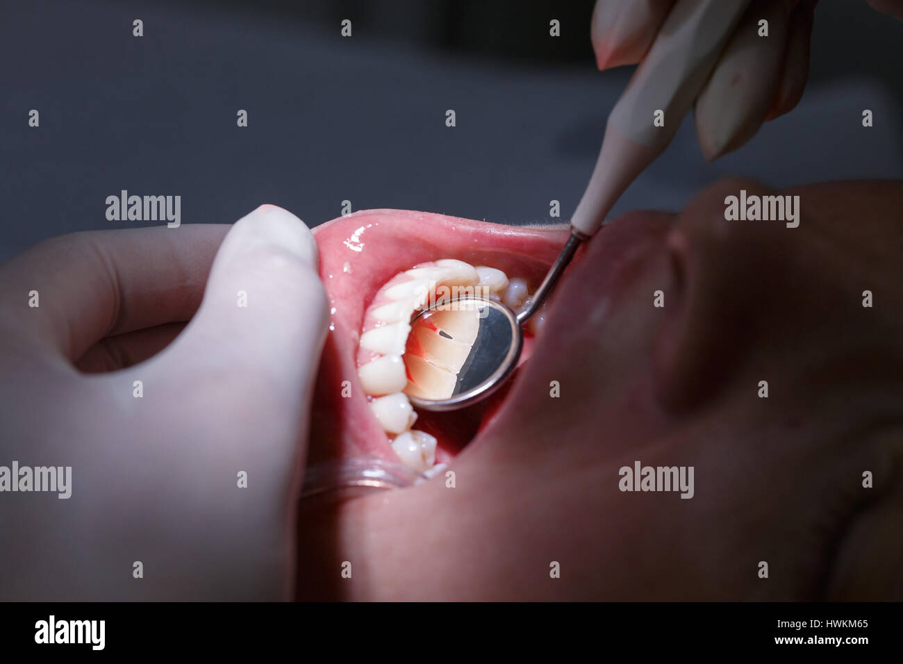 Patient at dentists office, getting her white teeth interdental spaces