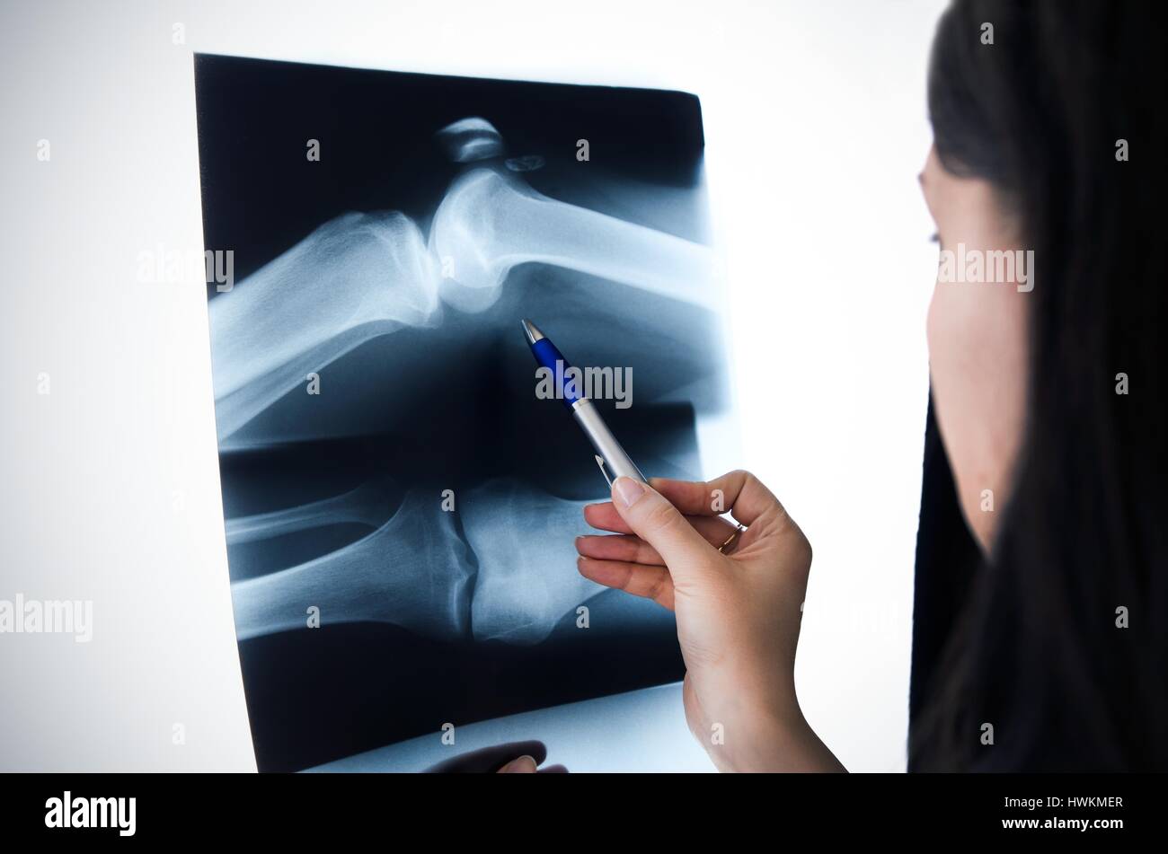X ray of knee hi-res stock photography and images - Alamy