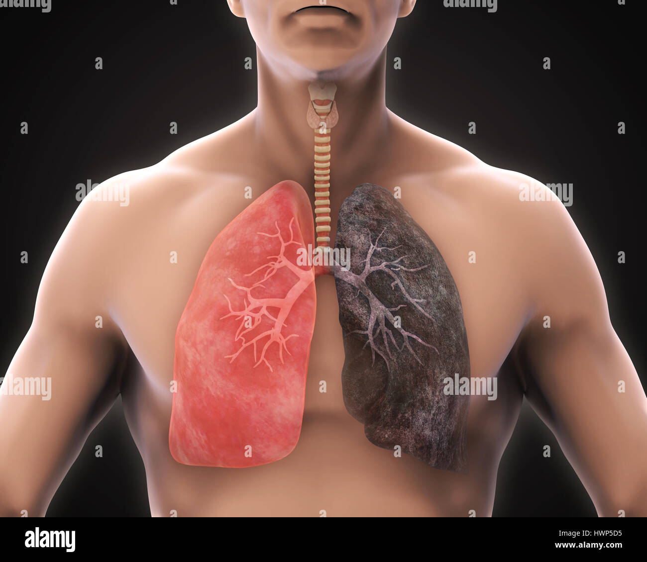 Smokers Lung High Resolution Stock Photography And Images Alamy
