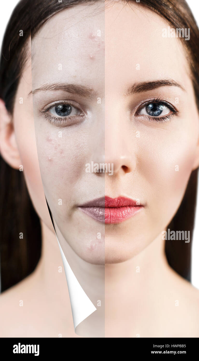 Layer with bad skin unstick from good healthy skin. Stock Photo