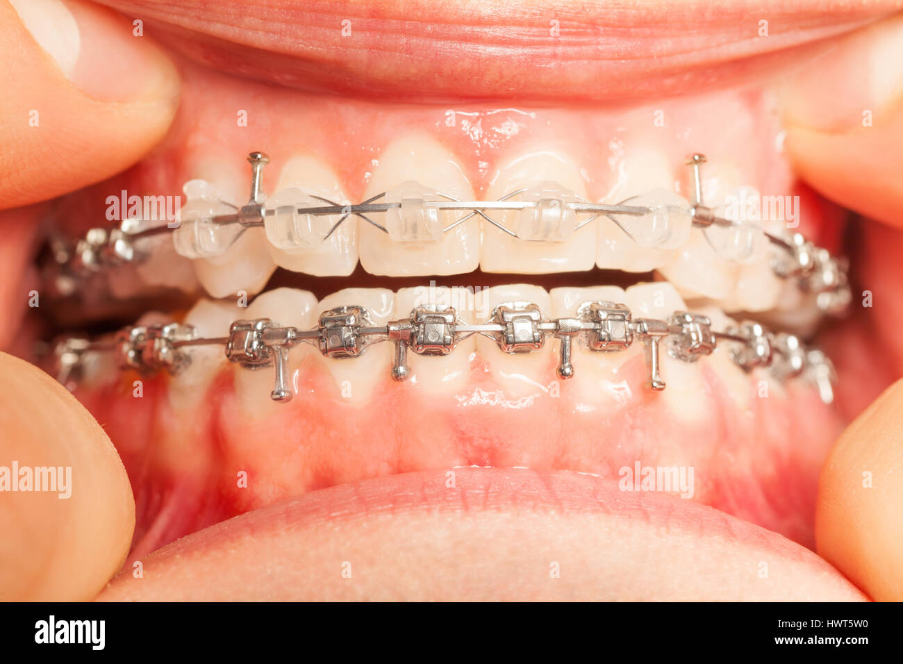 Jaw with braces installed on teeth closeup view Stock Photo Alamy
