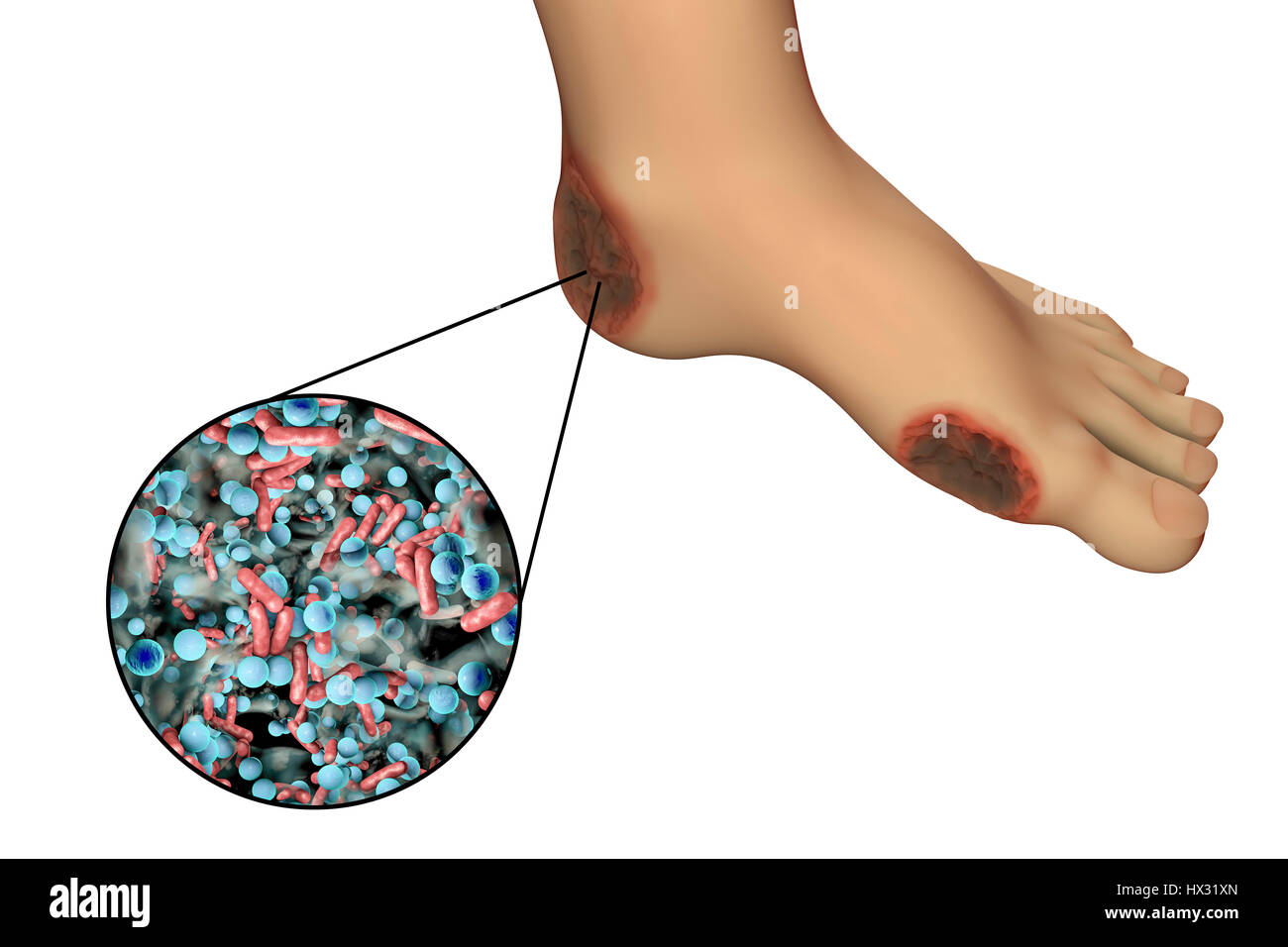 Destruction of human cytomegalovirus (HCMV), computer illustration. Conceptual image for HCMV infection treatment and prevention. HCMV is a member of the herpesvirus family. It has a high infection rate and is a major cause of disease in vulnerable newborns and immunocompromised patients, but does not typically cause disease in healthy adults. Stock Photo