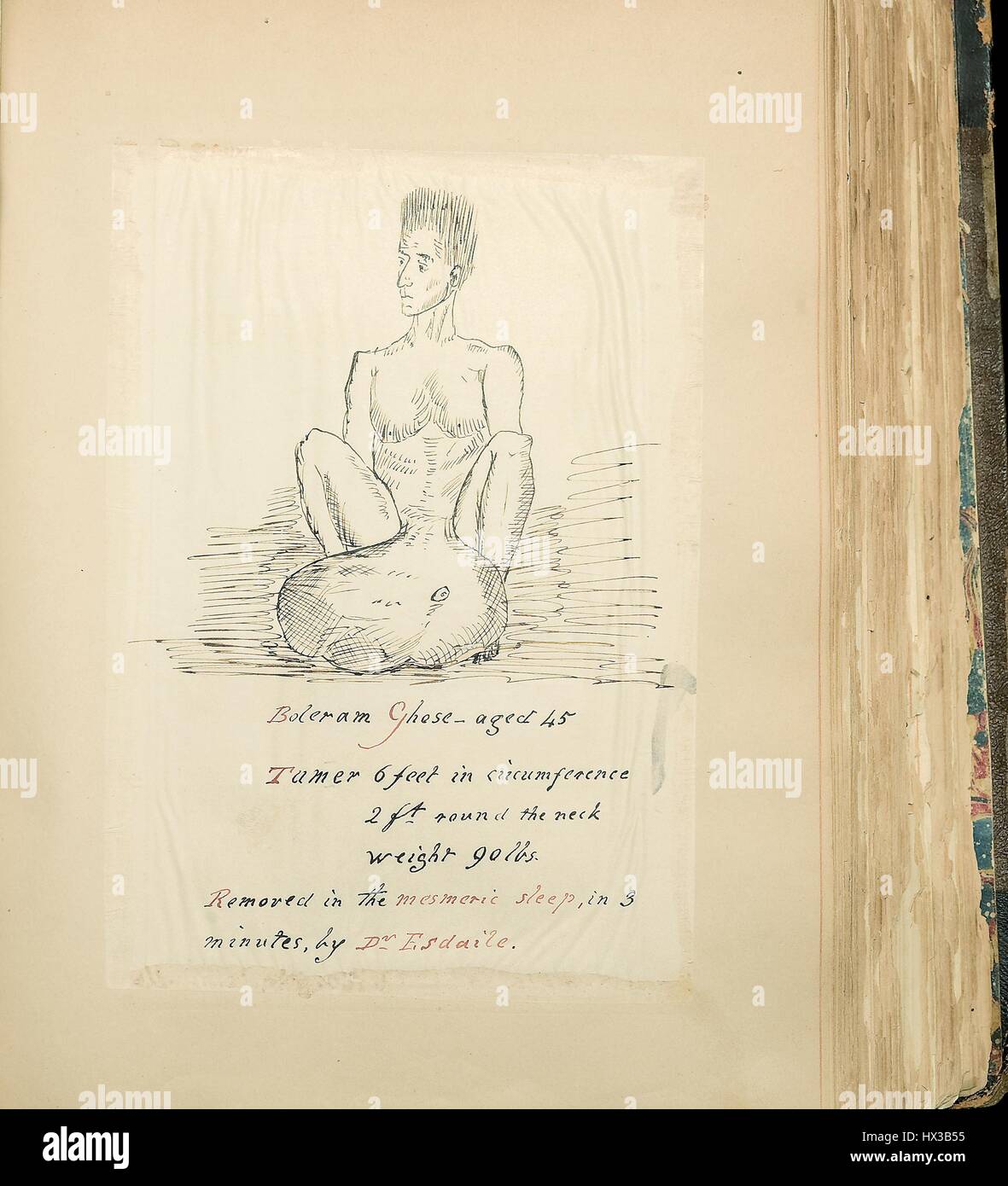 Drawing of Boleram Ghose, a man with a 90 lb tumor extending from his abdominal area, in 'Theodosius Purland, collection of materials on mesmerism.', 1854. Courtesy National Library of Medicine. Stock Photo