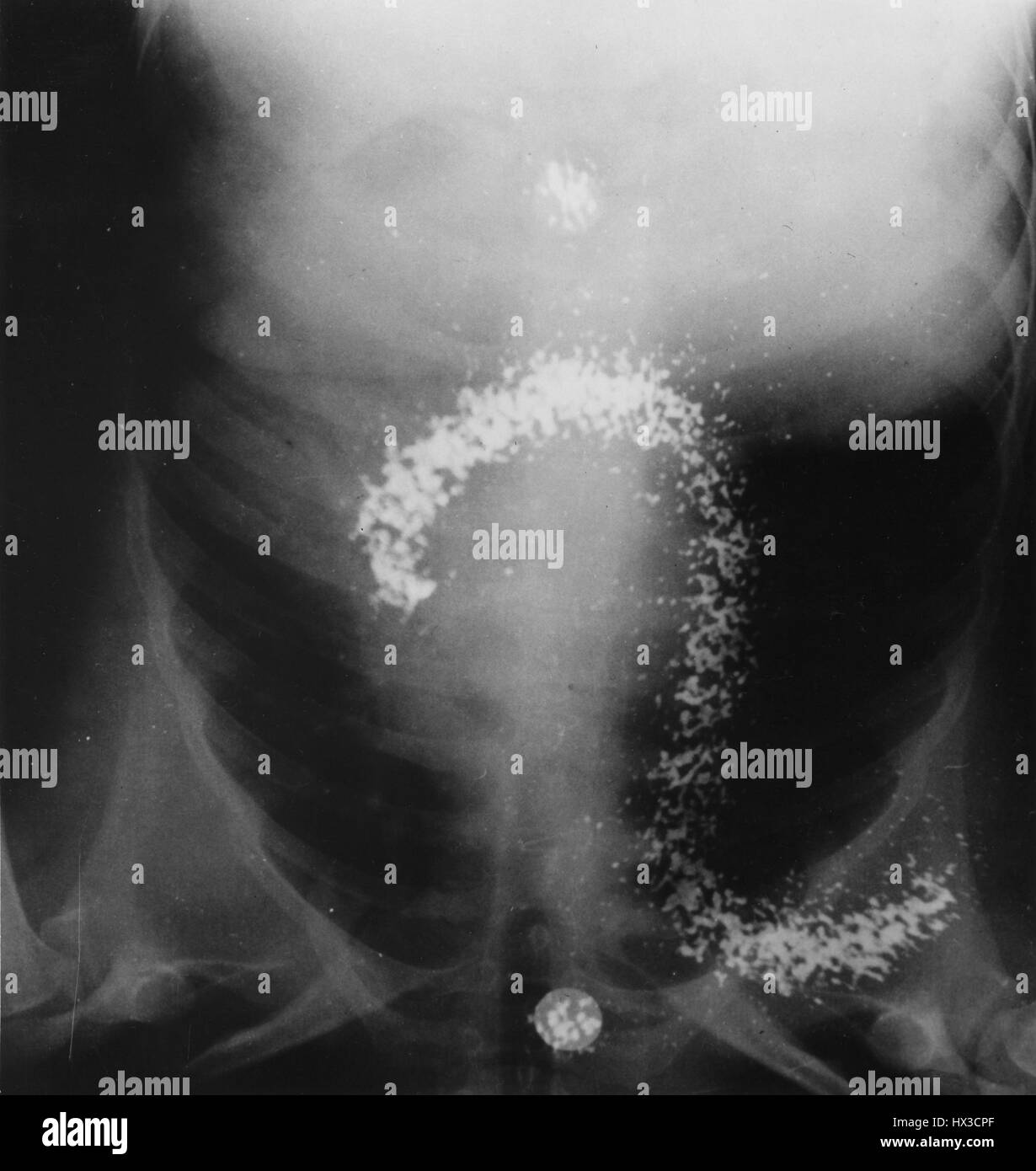 View of chest area during cardiac cauterization; taken with Scintillation camera developed at Donner Laboratory, Berkeley, California, 1972. Image courtesy US Department of Energy. Stock Photo