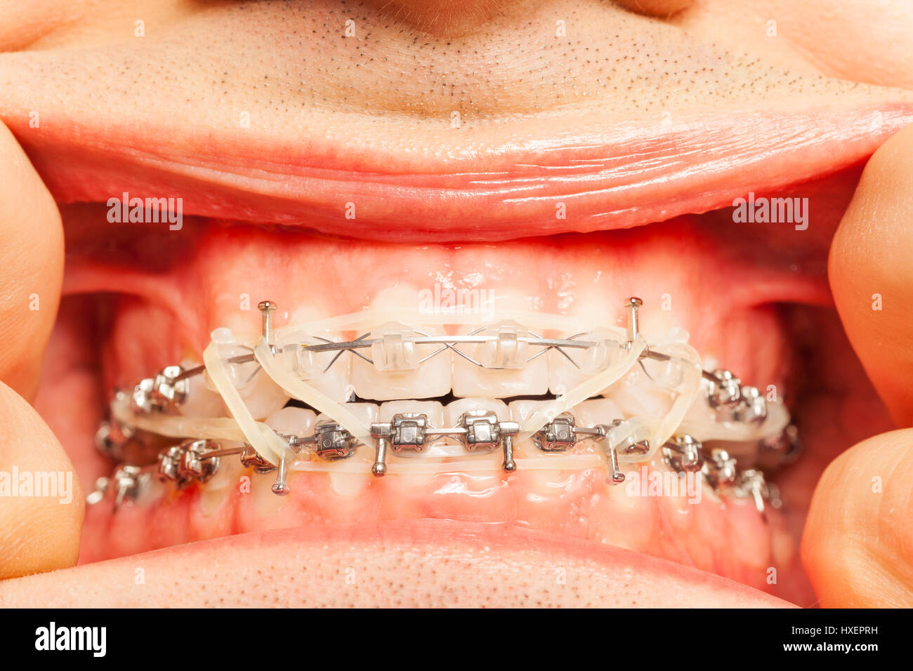 Close-up of man's mouth with braces and rubber correction strings on dental  hooks fixing position of teeth Stock Photo - Alamy