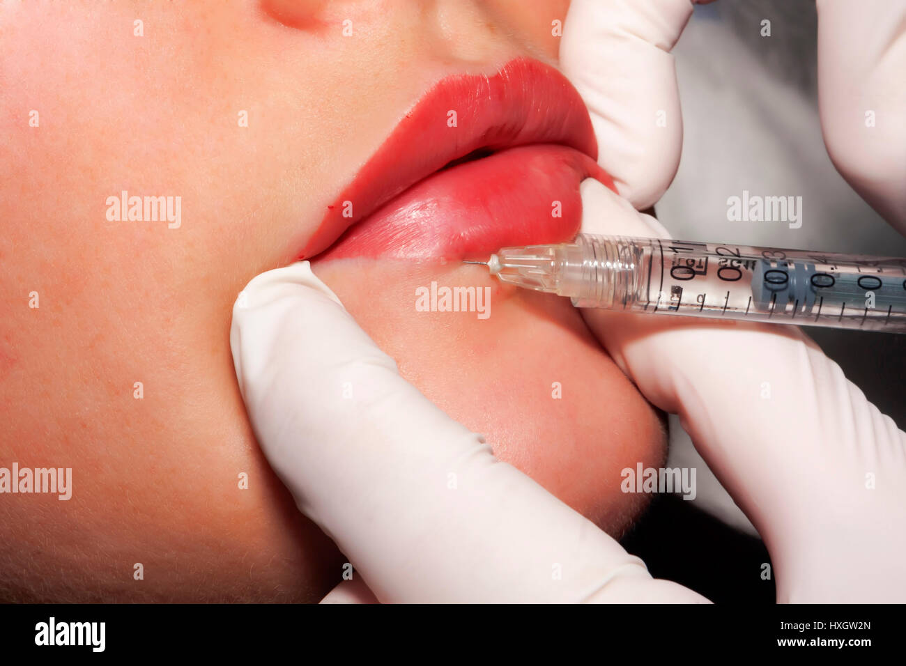 Contour plastic: Injection of filler Stock Photo - Alamy