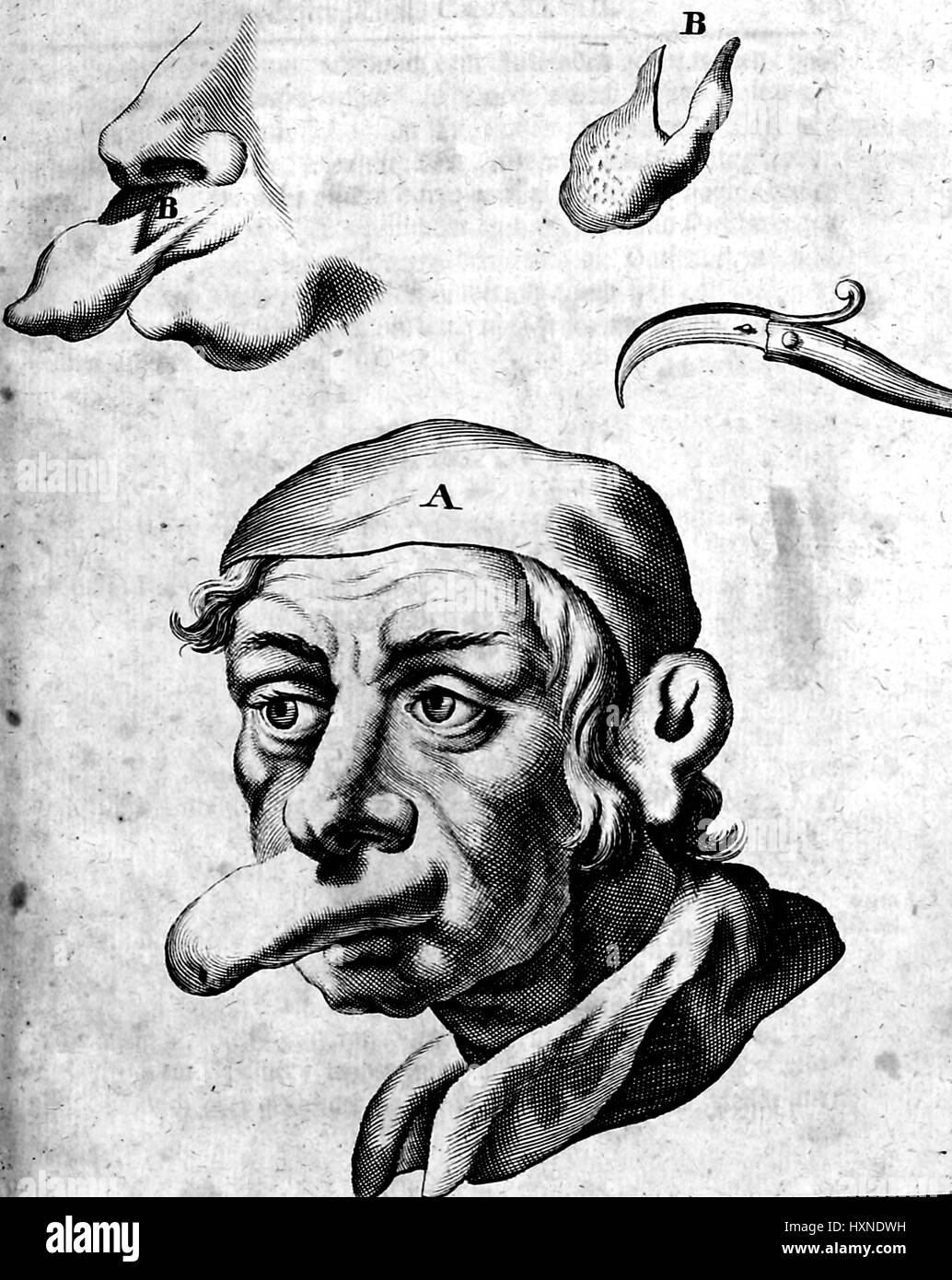 Medical illustration of a man with a large protruding lip deformity, as well as a detail view of the deformity, and a surgical tool used to remove the deformity, 1705. Stock Photo