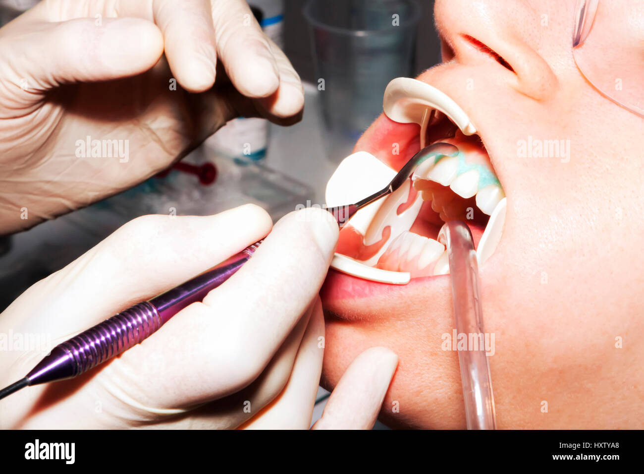 Dentist performs whitening treatment teeth at dental practice Stock Photo