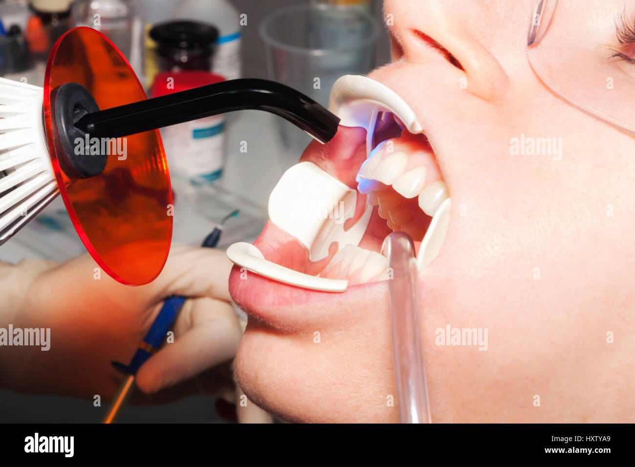 Dentist performs whitening treatment teeth at dental practice Stock Photo Alamy