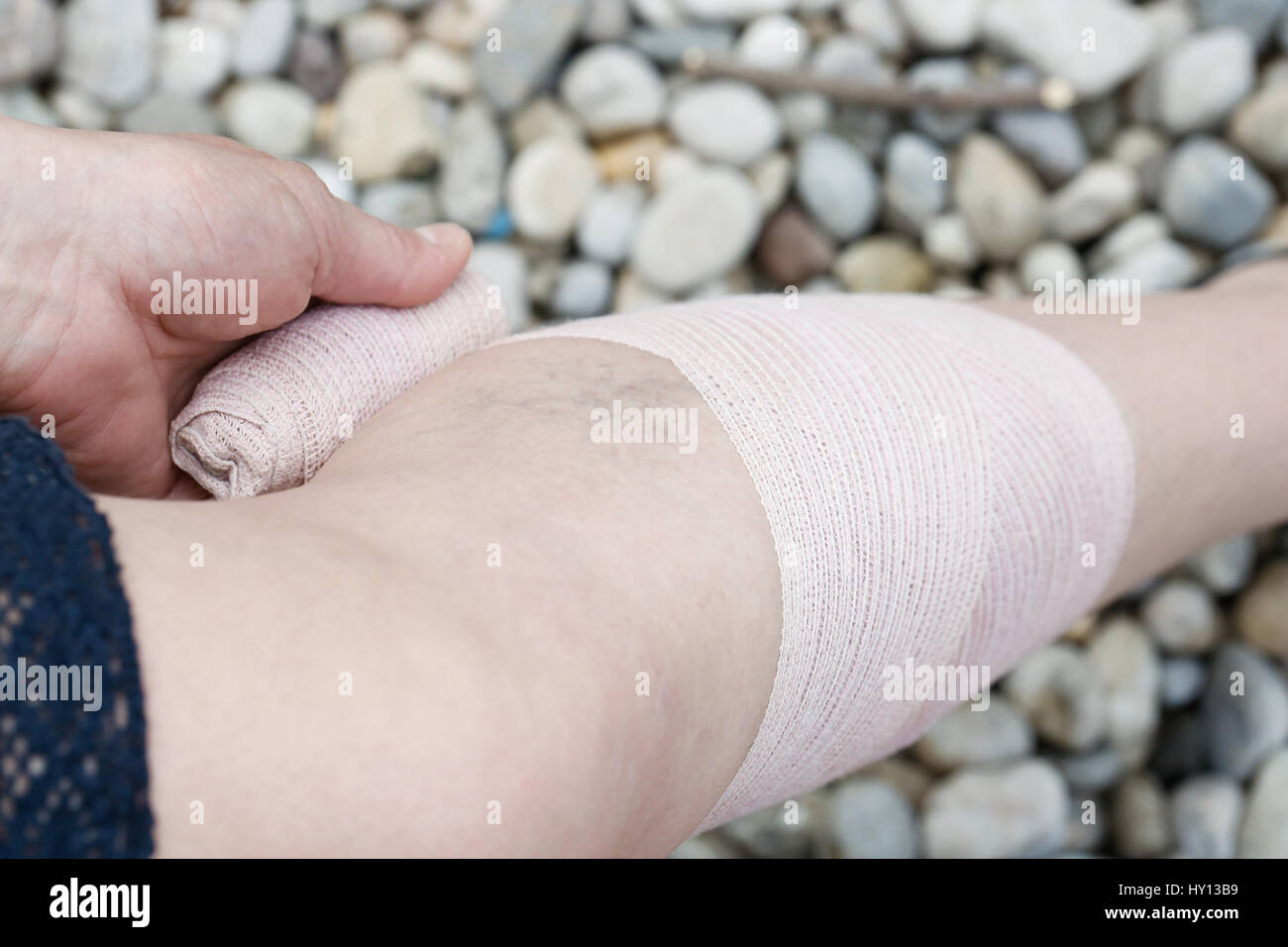 Woman with painful varicose and spider veins on her legs, applying compression bandage, self-helping herself. Vascular disease, varicose veins problem Stock Photo