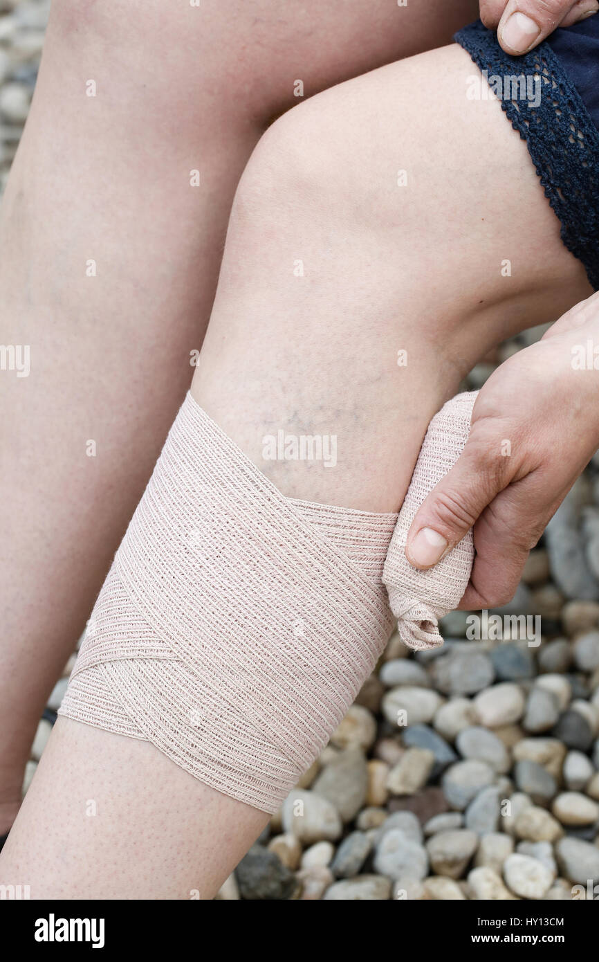 Woman with painful varicose and spider veins on her legs, applying compression bandage, self-helping herself. Vascular disease, varicose veins problem Stock Photo