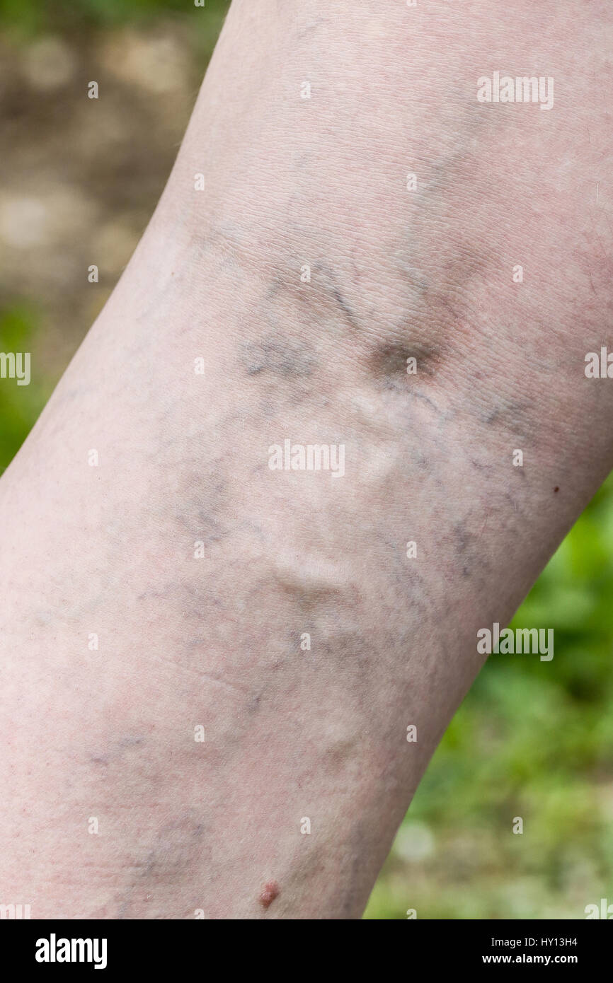 Woman with painful varicose and spider veins on her legs. Vascular disease, varicose veins problems, painful unaesthetic medical condition concept. Stock Photo
