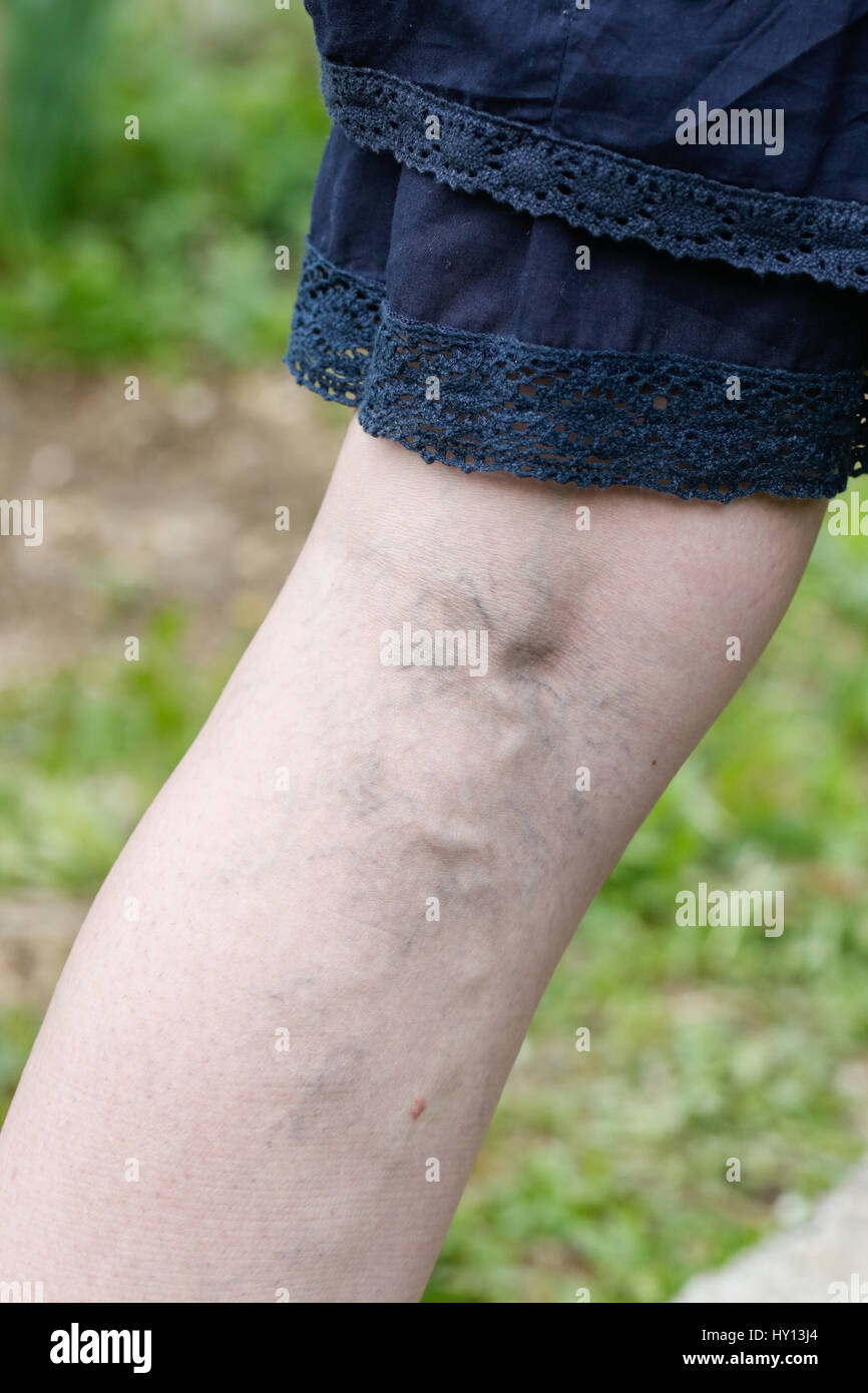 Woman with painful varicose and spider veins on her legs. Vascular disease, varicose veins problems, painful unaesthetic medical condition concept. Stock Photo