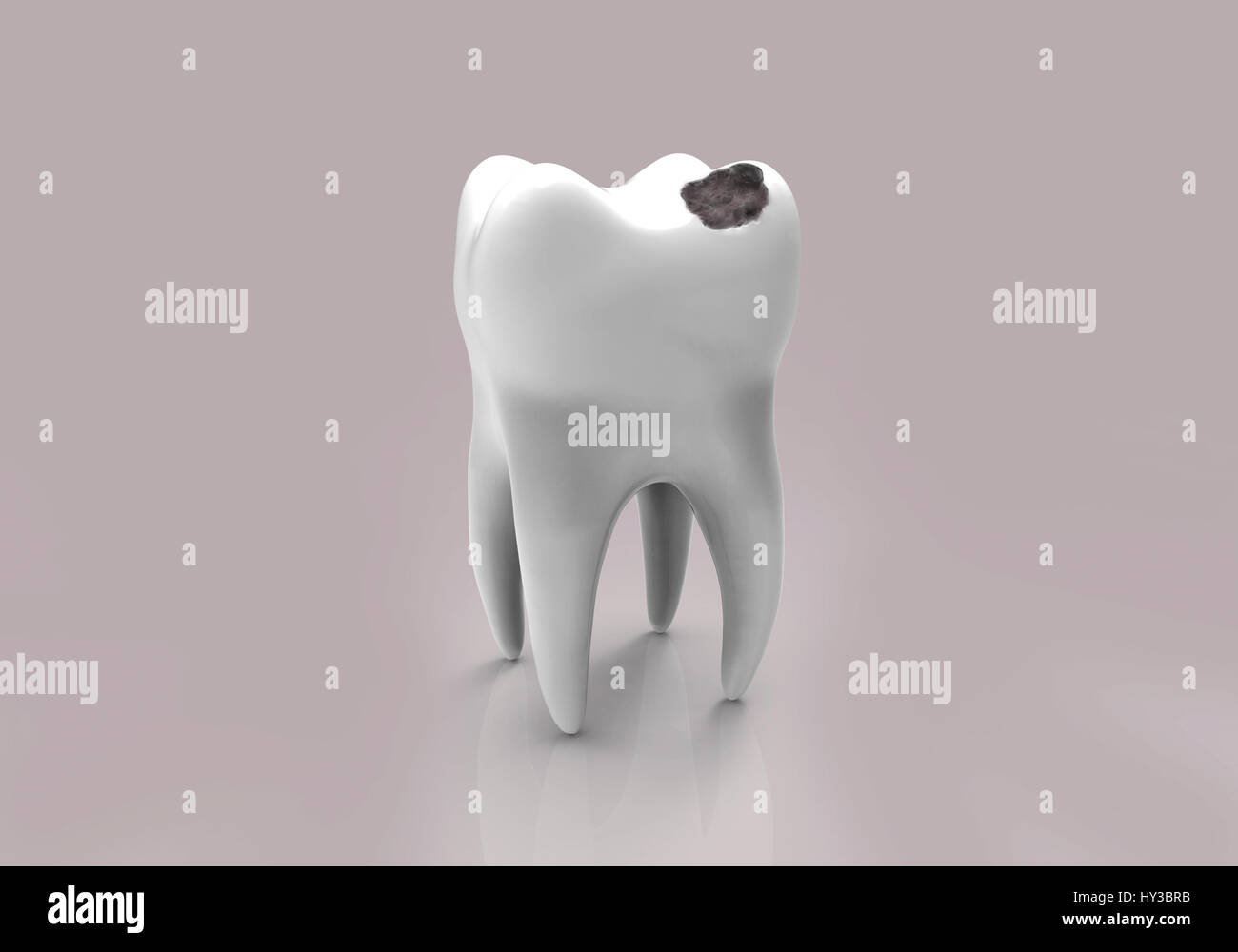 Tooth decay. Computer illustration of a tooth with a cavity. Stock Photo