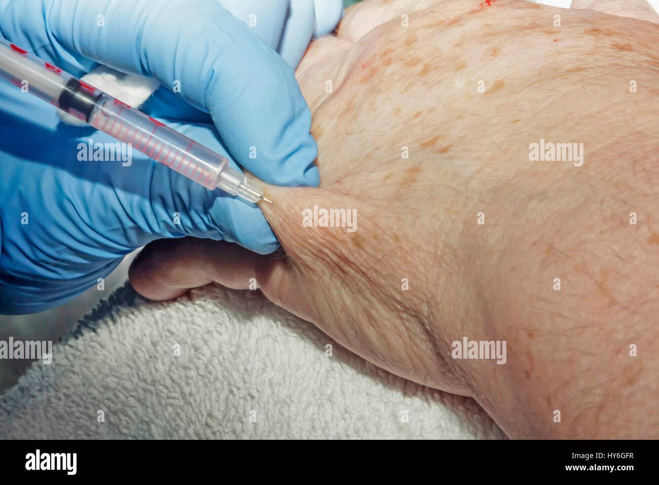 Microsurgery: Local anesthesia on the hand Stock Photo - Alamy
