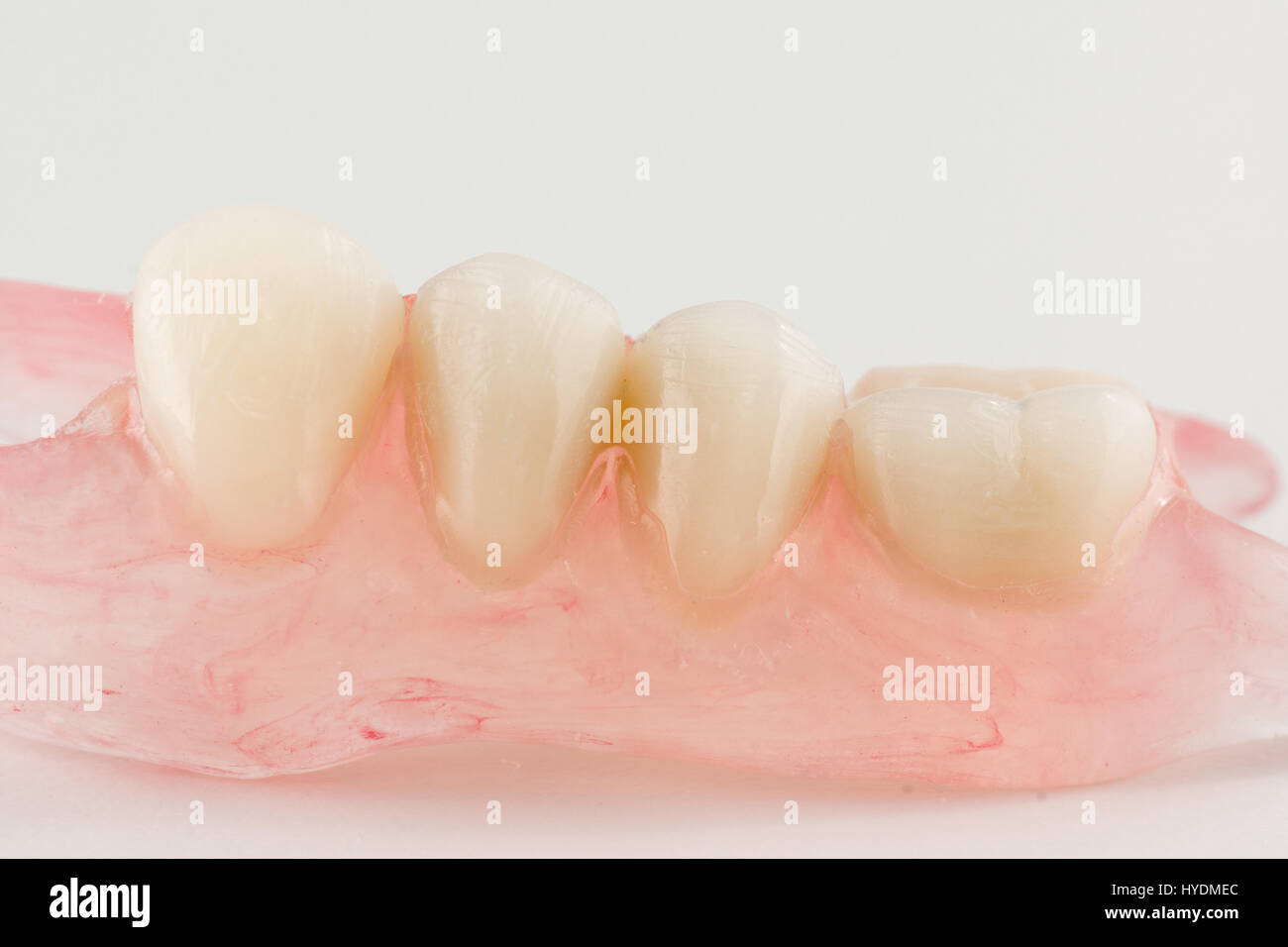 modern nylon removable dental prosthesis for restoring dentition Stock Photo