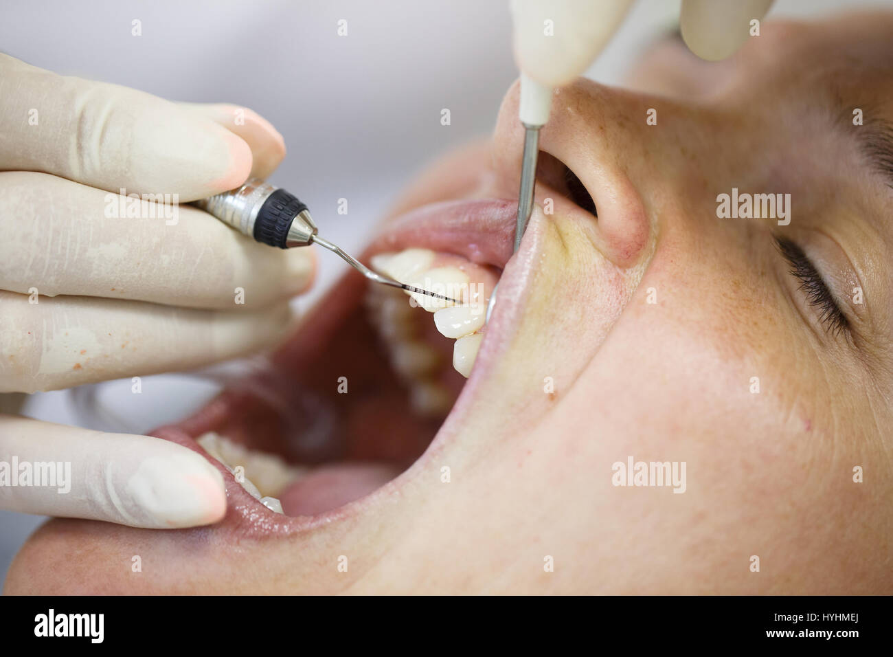 Periodontal probe, held by dental hygienist, measuring pocket depths around tooth, examining