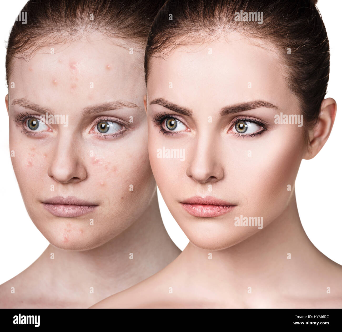 Girl with acne before and after treatment. Stock Photo