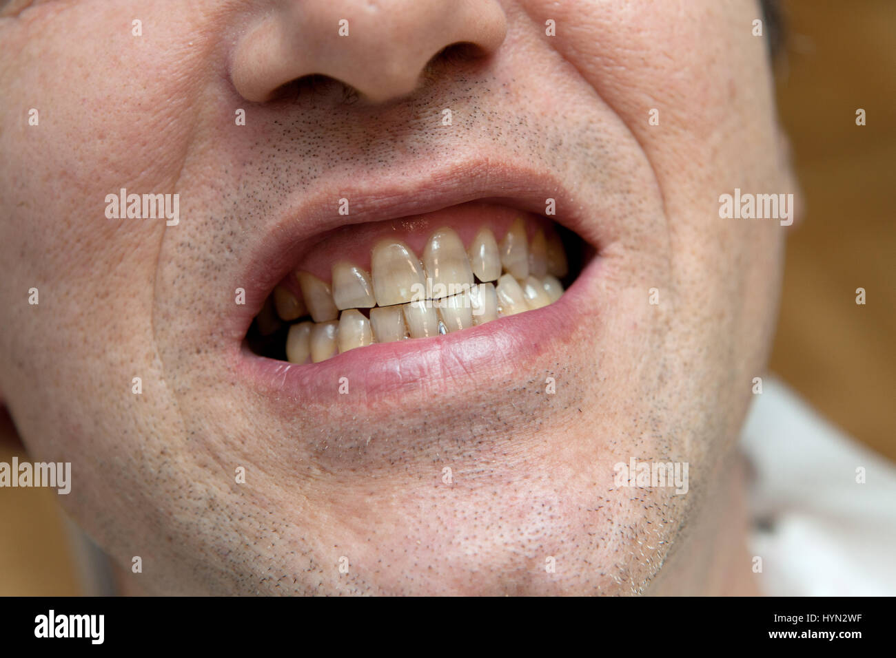 Man with yellow teeth. The harm of tobacco concept Stock Photo Alamy