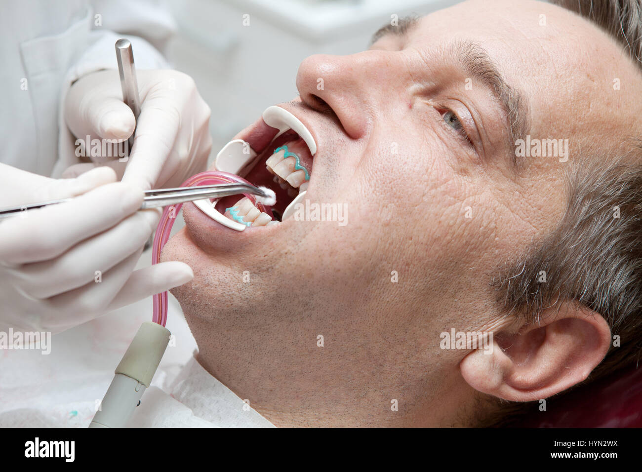 Man during teeth whitening process at the dentist office Stock Photo Alamy