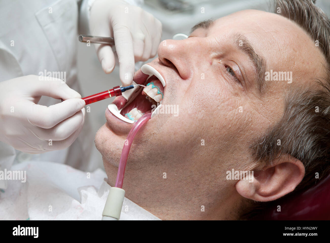 Man during teeth whitening process at the dentist office Stock Photo