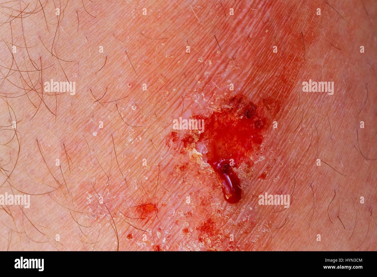 Closeup of wound and dry blood on leg. wound on the leg blood Stock Photo