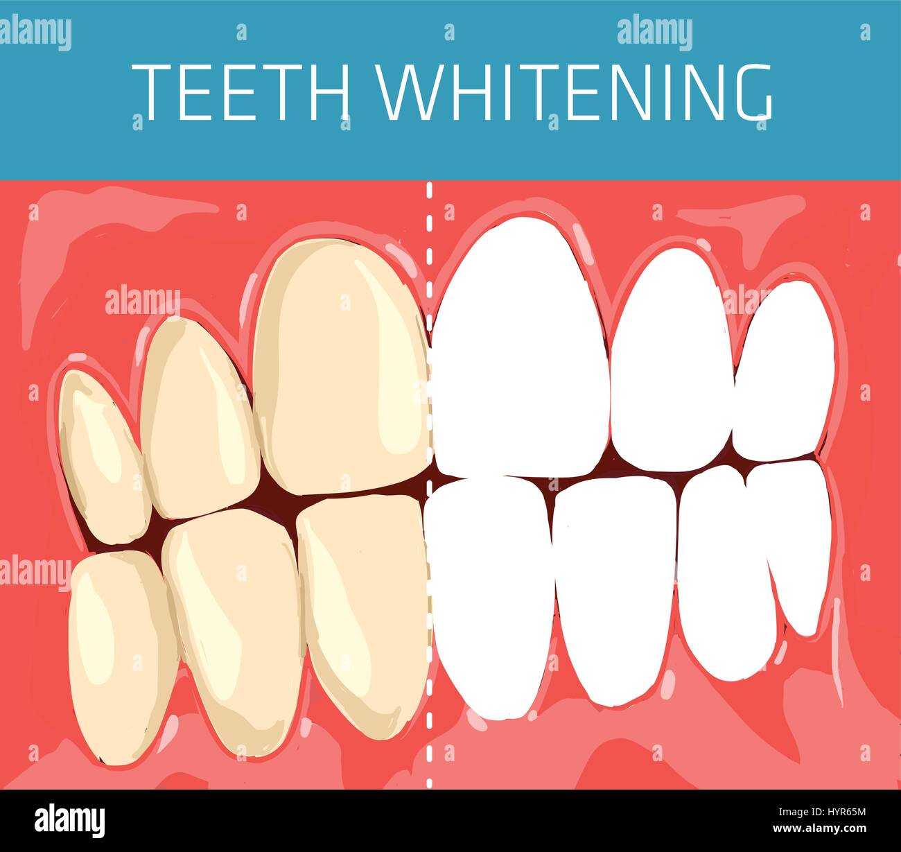 Medical and healthcare concept. Regular dental occlusion image. Teeth whitening visual scheme Stock Vector