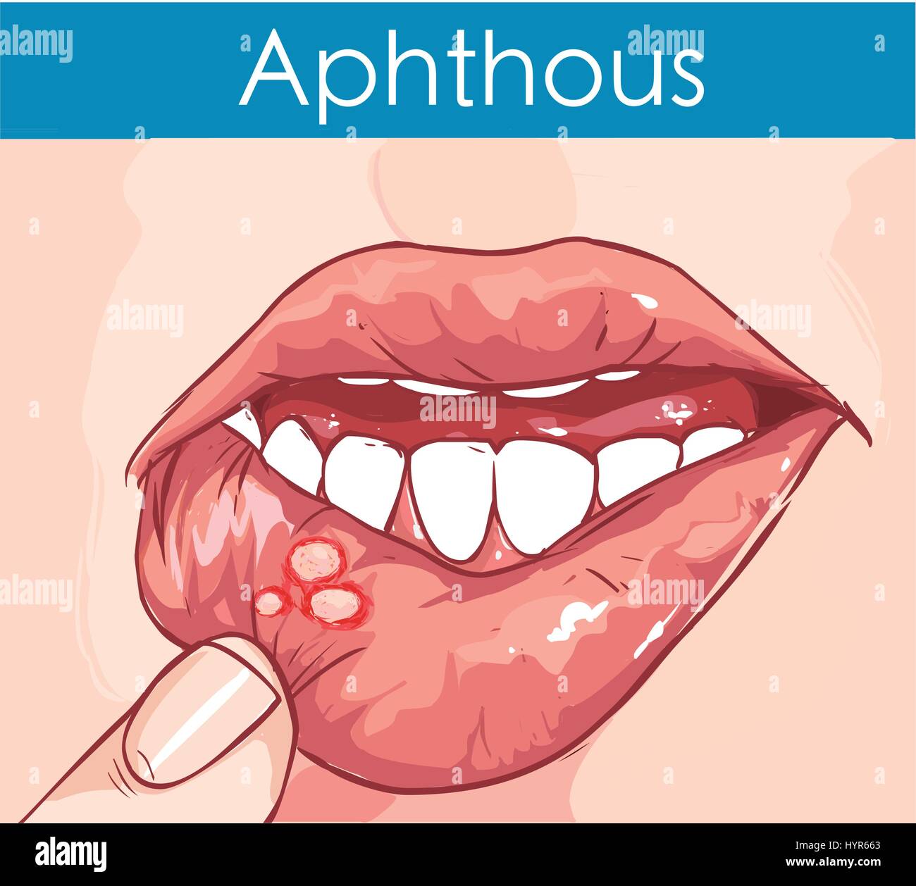 vector illustration of a Woman with aphthae on lip. Stock Vector