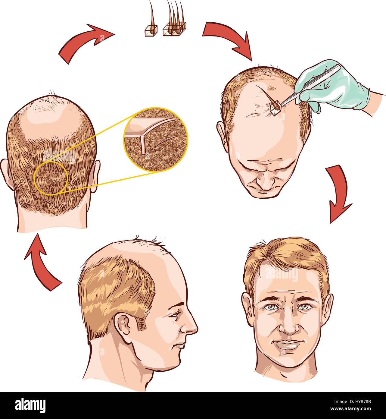 white background vector illustration of a hair transplantation Stock Vector