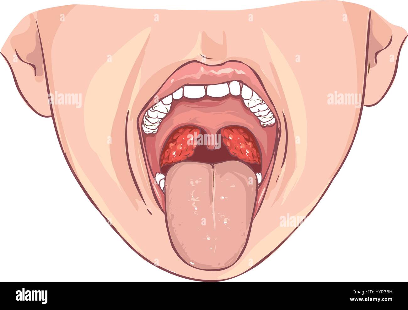 white background vector illustration of a tonsillitis bacterial Stock Vector