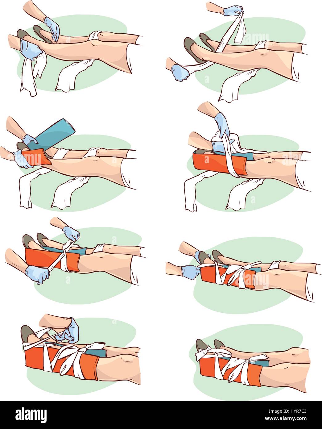 vector illustration of a Splinting a Broken leg Stock Vector