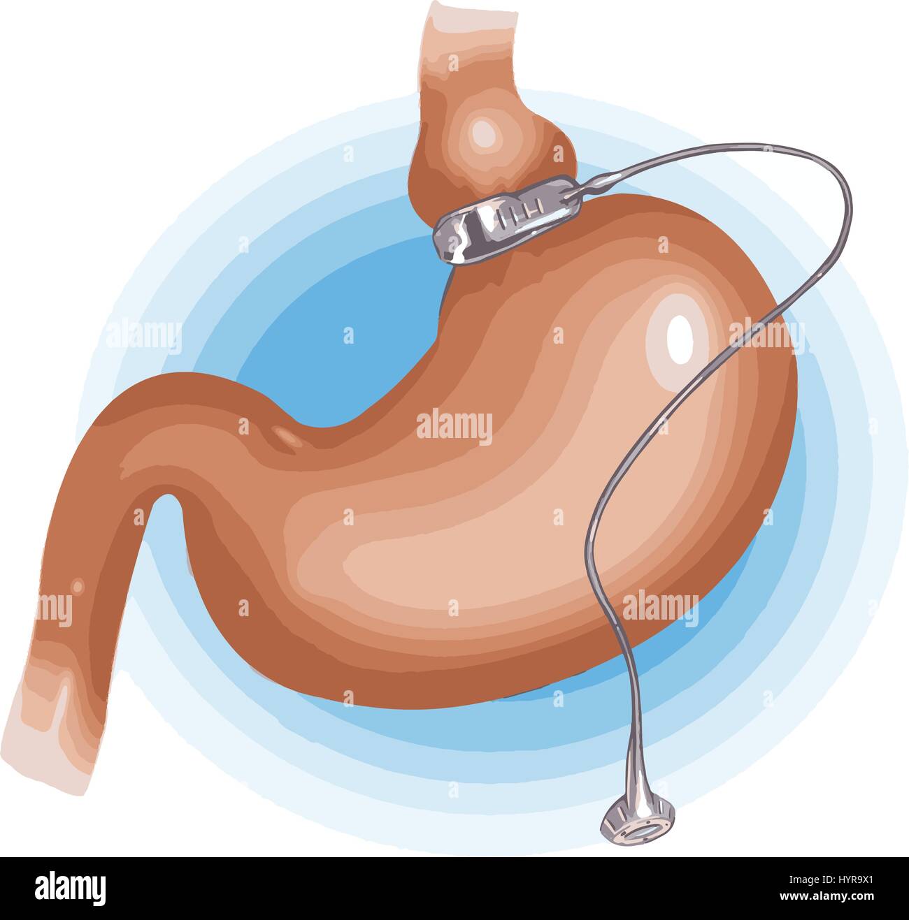Save Download Preview vector illustration of a Gastric Band Weight Loss