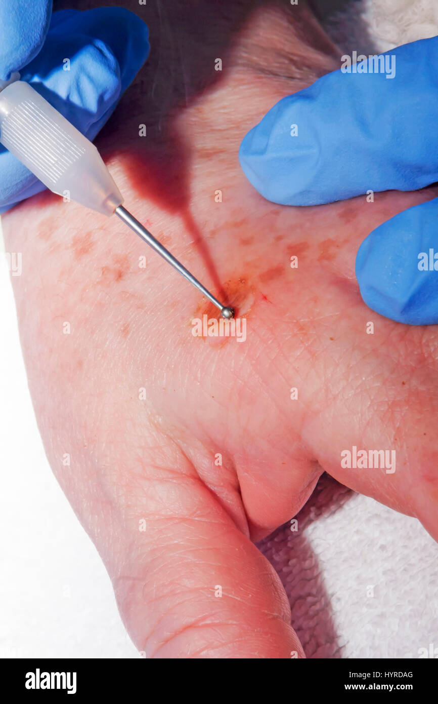 Electrocoagulation hires stock photography and images Alamy