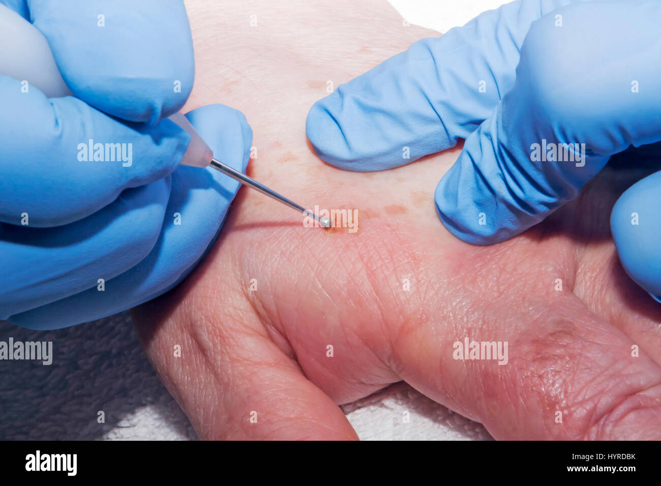 Microsurgery : Dermatologist removes skin diseases using eletrocautery Stock Photo