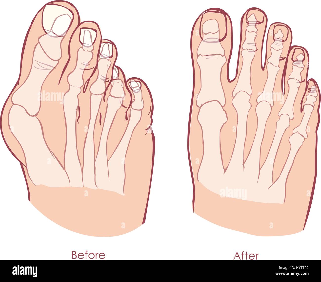 Human foot deformity. Hallux valgus and tailors bunion Stock Vector