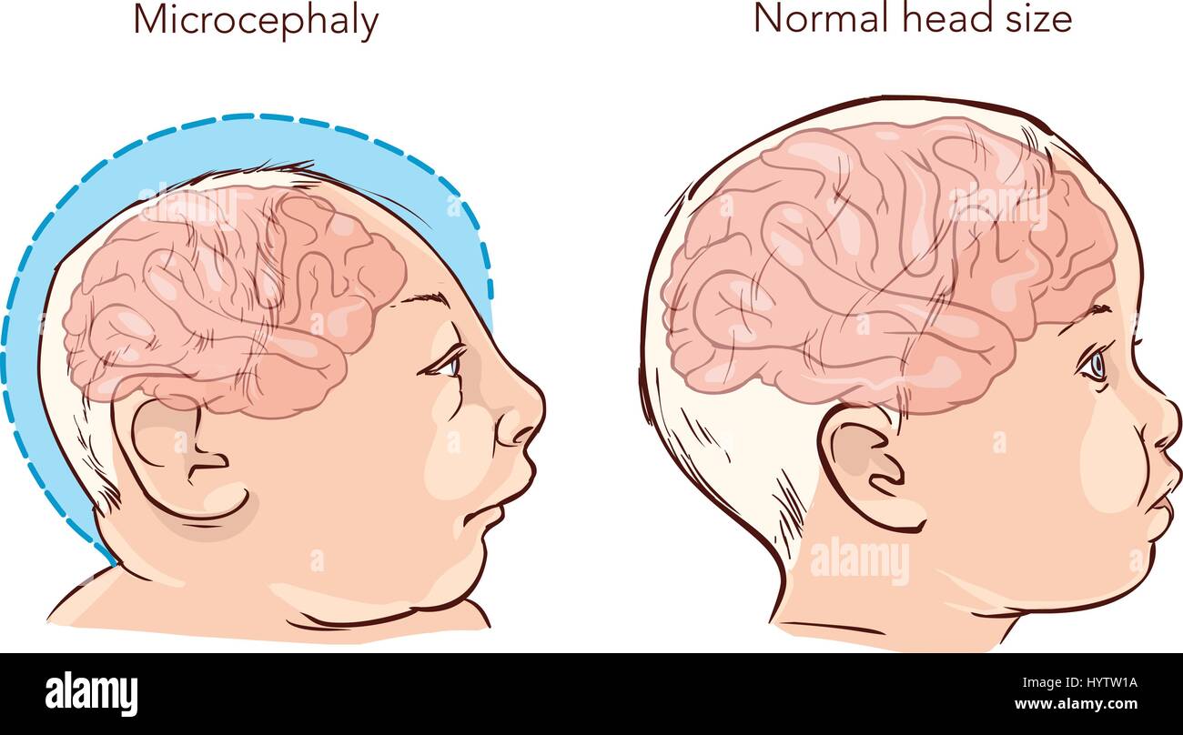 Illustration of a newborn baby with Microcephaly disease caused by Zika virus Stock Vector Image