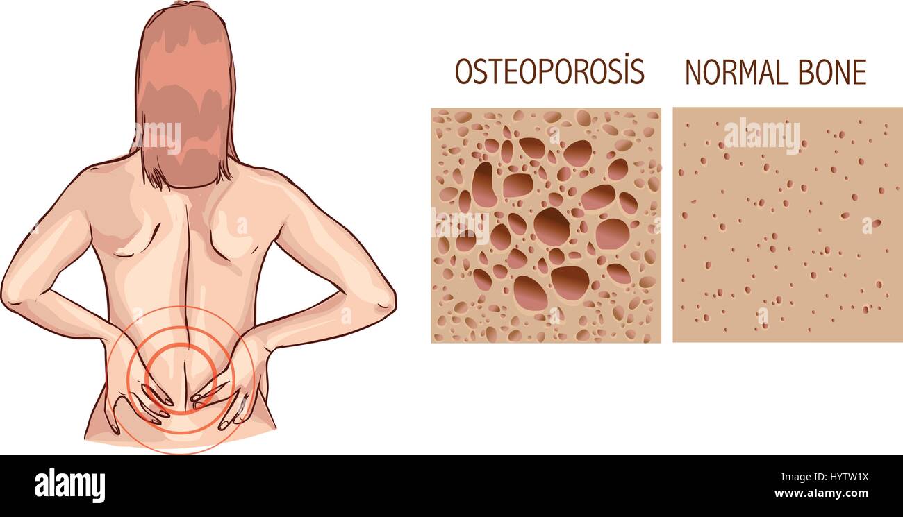 Osteoporosis, human bone anatomy. Medical illustration healthy bone and unhealthy bone Stock Vector