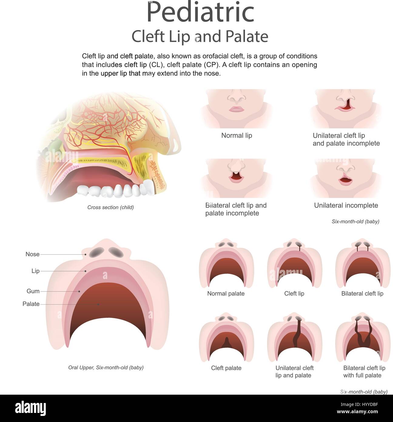 Cleft lip and cleft palate, also known as orofacial is a group of conditions that includes cleft lip Stock Vector