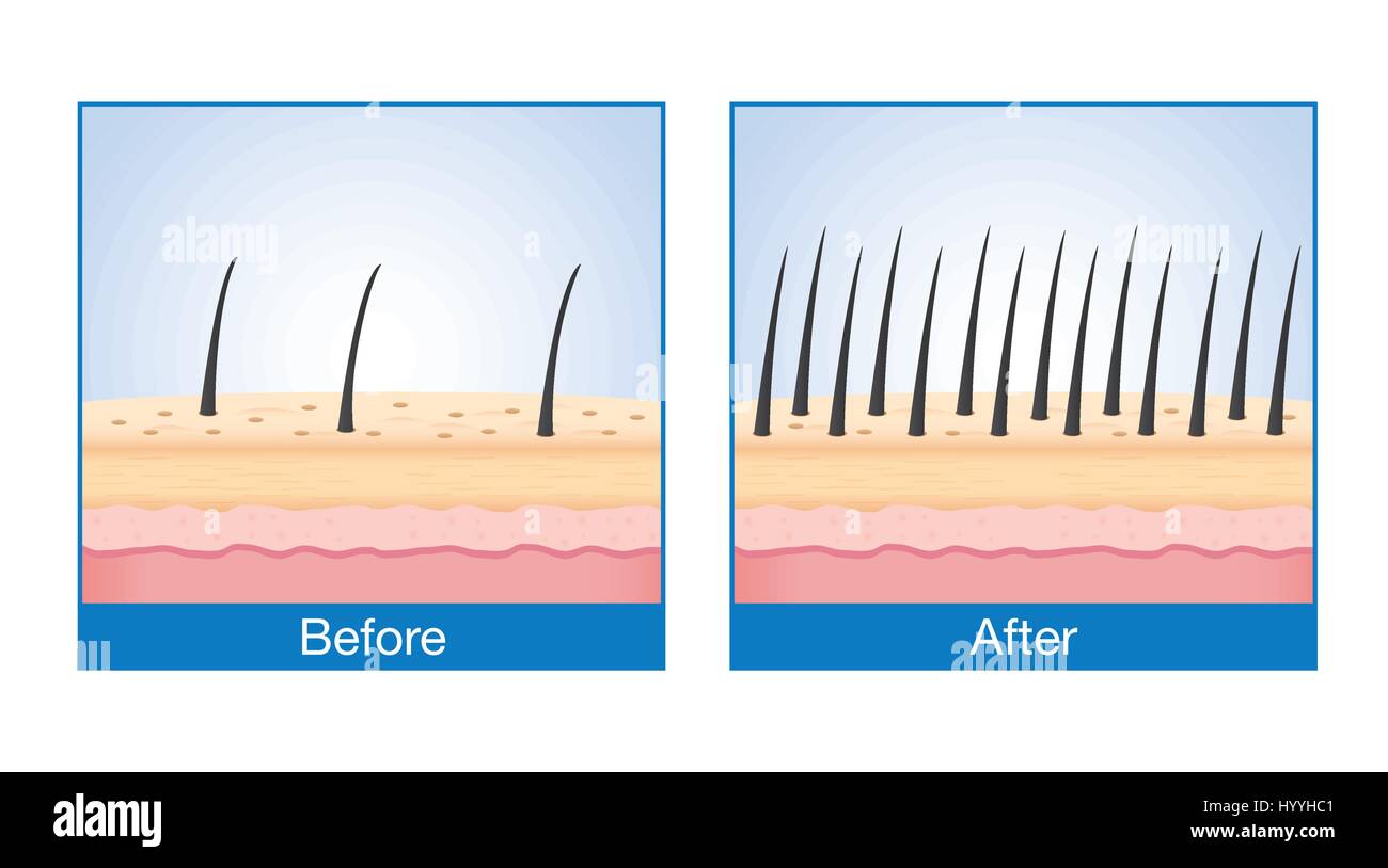 Hair loss hi-res stock photography and images - Alamy Hair loss hi-res stock photography and images - Alamy