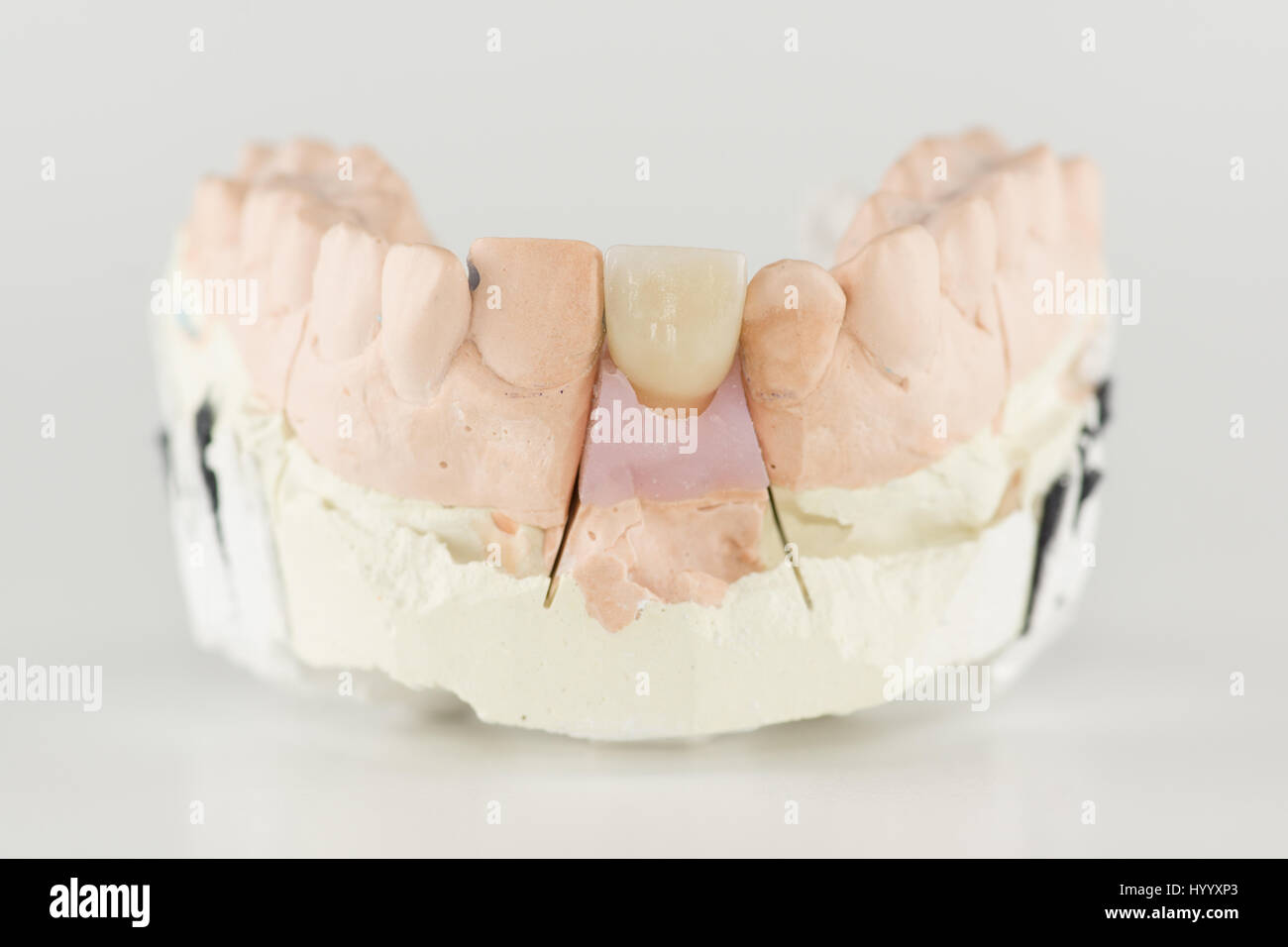 metal-ceramic dental crown is tried on an artificial model Stock Photo