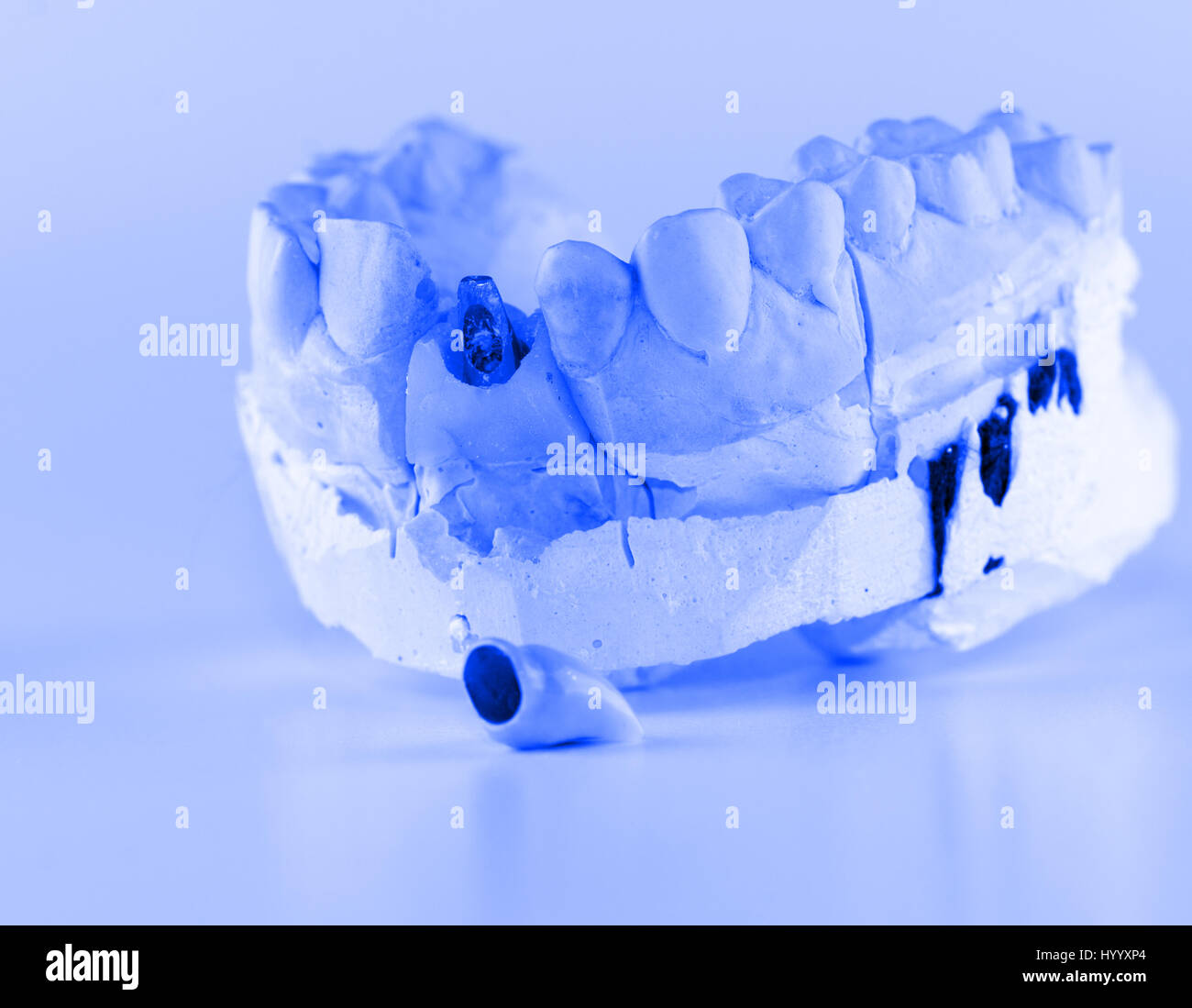 metal-ceramic dental crown is tried on an artificial model Stock Photo