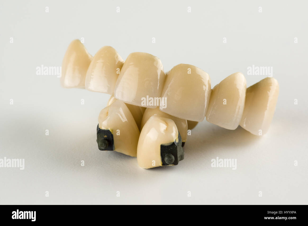 Metalceramic tooth crowns with locks for fixing removable prostheses