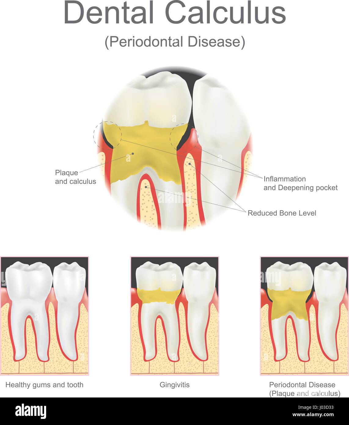 Tartar on Teeth (Dental Calculus): Causes & Removal