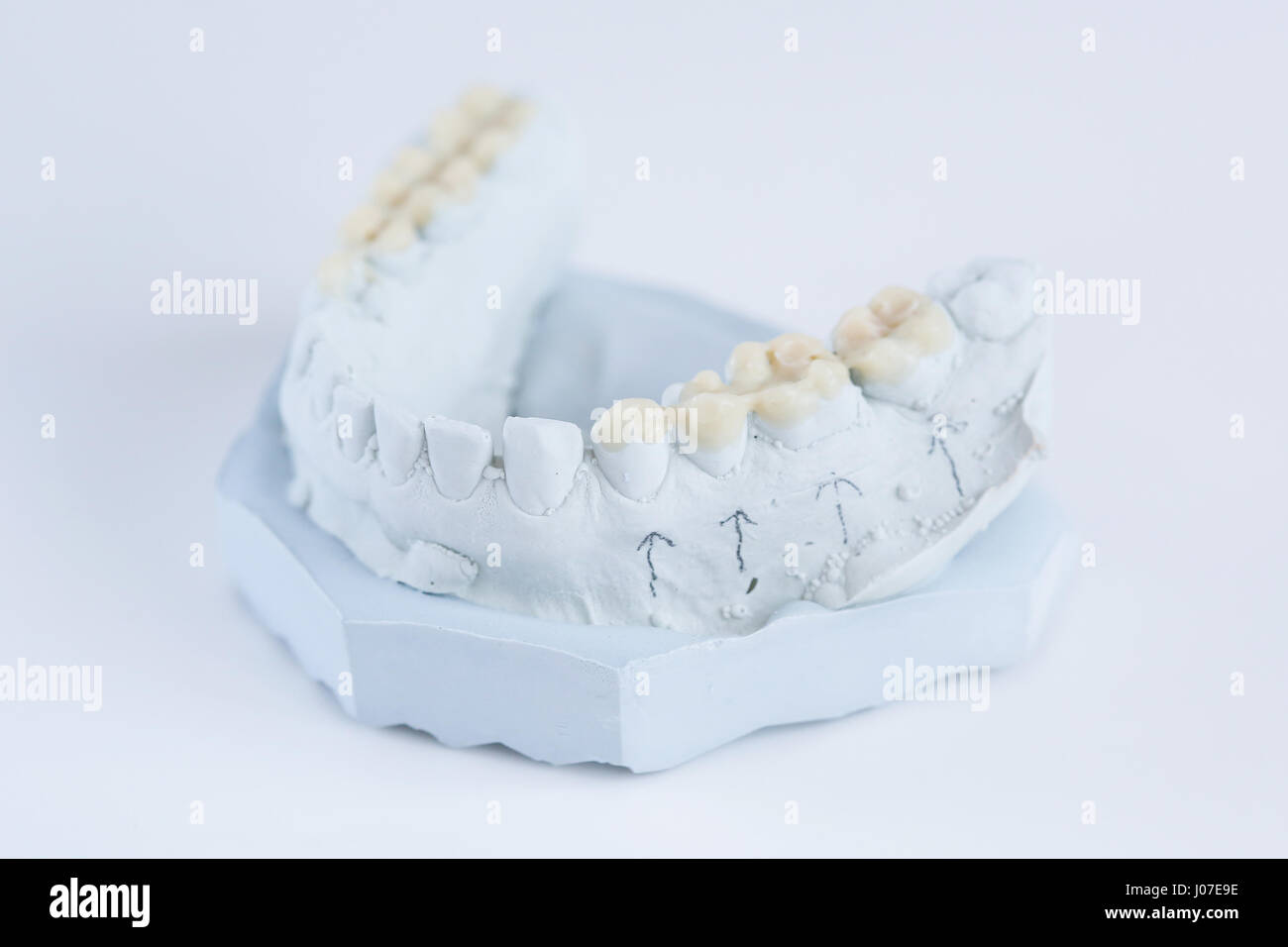 Plaster Dental Mold With Blue Painted Teeth Stock Photo - Download Image  Now - Anatomy, Blue, Color Image - iStock