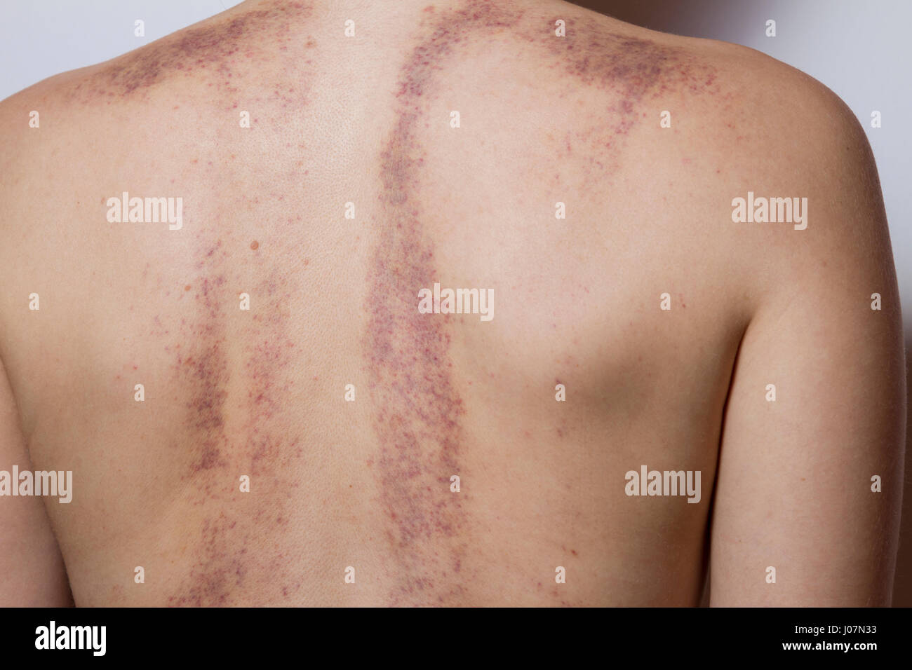 Bad Bruises On Back