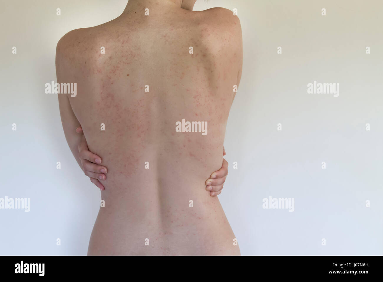 Allergy rash on back of woman isolated on white. Soft Focus Stock Photo