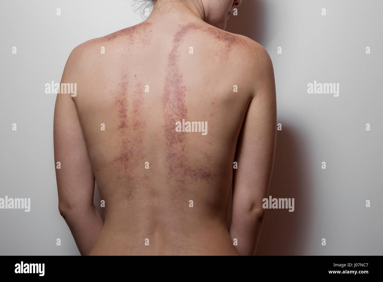 Bruises on back hi-res stock photography and images - Alamy