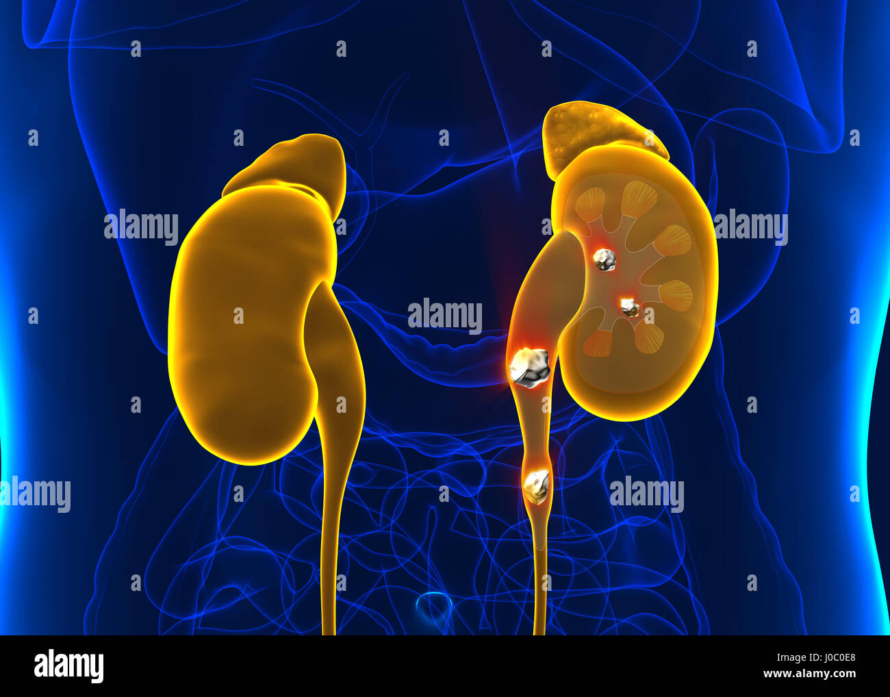 Kidney stones anatomy pain male internal organ painful cristaline mineral cross section - 3d illustration Stock Photo